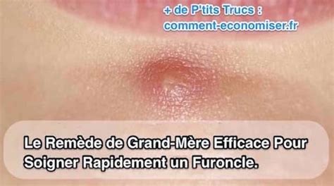 comment soigner un furoncle fessier|Comment traiter un furoncle du fessier